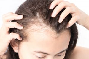 علت ریزش مو در رژیم کتوژنیک چیست؟